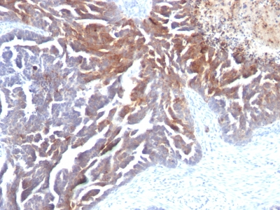 FFPE human ovarian carcinoma sections stained with 100 ul anti-TAG-72 / CA72.4 (clone CC49) at 1:300. HIER epitope retrieval prior to staining was performed in 10mM Citrate, pH 6.0.